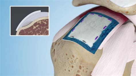 patch saddle nephew|REGENETEN Bioinductive Implant .
